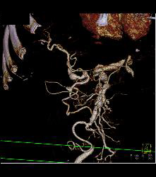 Hepatic Artery Aneurysm - CTisus CT Scan