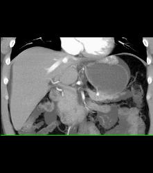 Hemangioma - CTisus CT Scan