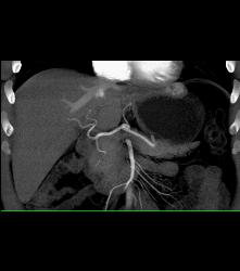 Reflux of Contrast Into IVC - CTisus CT Scan