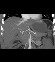 Reflux of Contrast Into IVC - CTisus CT Scan