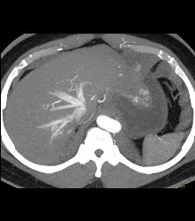 Reflux of Contrast Into IVC - CTisus CT Scan