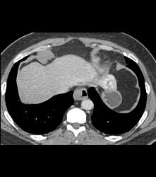 Multifocal Hepatocellular Carcinoma (Hepatoma) - CTisus CT Scan