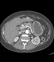 Multifocal Hepatocellular Carcinoma (Hepatoma) - CTisus CT Scan