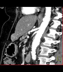 Multifocal Hepatocellular Carcinoma (Hepatoma) - CTisus CT Scan