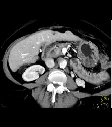 Multifocal Hepatocellular Carcinoma (Hepatoma) - CTisus CT Scan