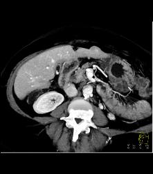 Multifocal Hepatocellular Carcinoma (Hepatoma) - CTisus CT Scan