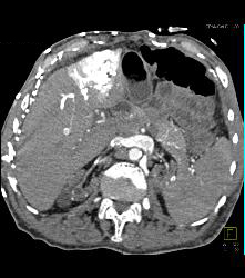 SVC Occlusion With Hot Spot Liver and Extensive Collaterals - CTisus CT Scan