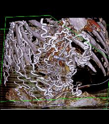 SVC Occlusion With Hot Spot Liver and Extensive Collaterals - CTisus CT Scan