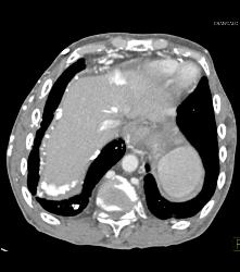 SVC Occlusion With Hot Spot Liver and Extensive Collaterals - CTisus CT Scan