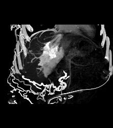 SVC Occlusion With Hot Spot Liver and Extensive Collaterals - CTisus CT Scan