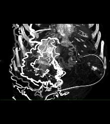 SVC Occlusion With Hot Spot Liver and Extensive Collaterals - CTisus CT Scan