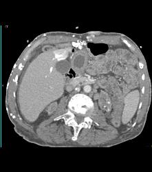 SVC Occlusion With Hot Spot Liver and Extensive Collaterals - CTisus CT Scan