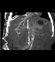 SVC Occlusion With Hot Spot Liver and Extensive Collaterals - CTisus CT Scan