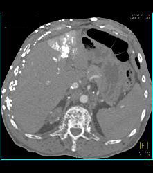 SVC Occlusion With Hot Spot Liver and Extensive Collaterals - CTisus CT Scan