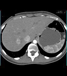 Focal Nodular Hyperplasia (FNH) - CTisus CT Scan