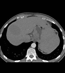 Hepatic Cyst and Incredible Cirrhosis - CTisus CT Scan