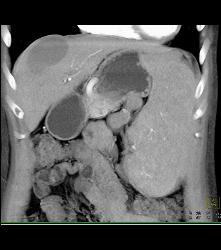 Hepatic Cyst and Incredible Cirrhosis - CTisus CT Scan