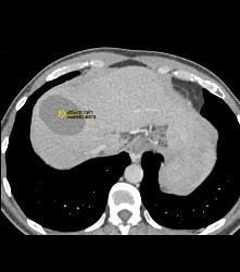 Hepatic Cyst and Incredible Cirrhosis - CTisus CT Scan