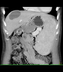 Hepatic Cyst and Incredible Cirrhosis - CTisus CT Scan