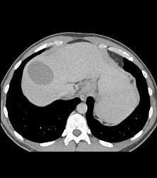 Hepatic Cyst and Incredible Cirrhosis - CTisus CT Scan