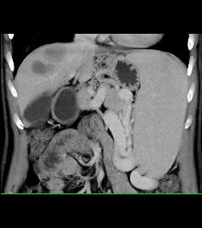 Hepatic Cyst and Incredible Cirrhosis - CTisus CT Scan