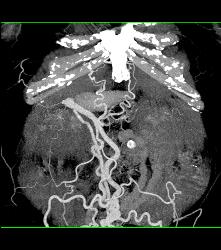 Hepatic Cyst and Incredible Cirrhosis - CTisus CT Scan