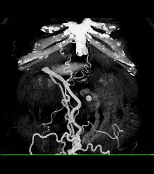 Hepatic Cyst and Incredible Cirrhosis - CTisus CT Scan