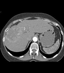 Hepatocellular Carcinoma (Hepatoma) - CTisus CT Scan