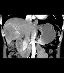 Hepatocellular Carcinoma (Hepatoma) - CTisus CT Scan