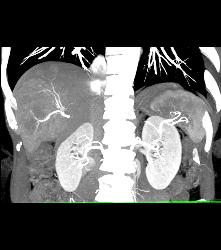 Hepatocellular Carcinoma (Hepatoma) - CTisus CT Scan