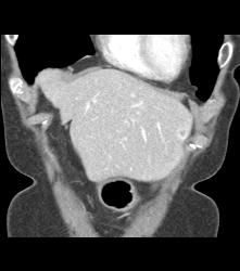 Hepatocellular Carcinoma (Hepatoma) - CTisus CT Scan