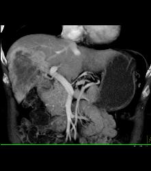 Hepatocellular Carcinoma (Hepatoma) - CTisus CT Scan