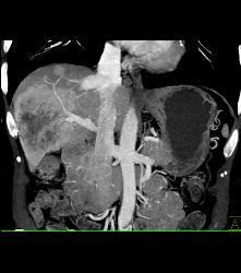 Hepatocellular Carcinoma (Hepatoma) - CTisus CT Scan