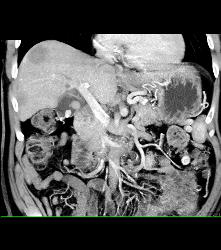 Liver Metastases - CTisus CT Scan