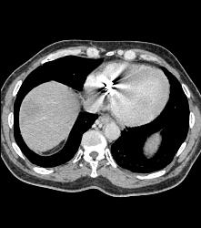 Liver Metastases - CTisus CT Scan