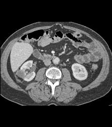 Adrenal Mets From Carcinoid - CTisus CT Scan