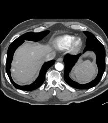 Hepatic Arteriovenous Malformations (AVMs) in A Patient With Pulmonary AVMs and Hereditary Hemorrhagic Telangiectasia (HHT) Syndrome - CTisus CT Scan