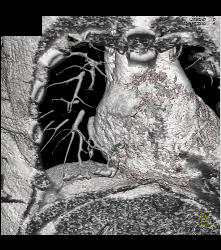 Hepatic Arteriovenous Malformations (AVMs) in A Patient With Pulmonary AVMs and Hereditary Hemorrhagic Telangiectasia (HHT) Syndrome - CTisus CT Scan