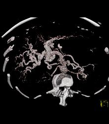 Hepatic Arteriovenous Malformations (AVMs) in A Patient With Pulmonary AVMs and Hereditary Hemorrhagic Telangiectasia (HHT) Syndrome - CTisus CT Scan