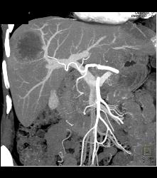 Metastatic Colon Cancer With Hypovascular Metastases - CTisus CT Scan