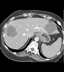 Metastatic Colon Cancer With Hypovascular Metastases - CTisus CT Scan