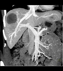 Metastatic Colon Cancer With Hypovascular Metastases - CTisus CT Scan