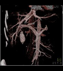 Metastatic Colon Cancer With Hypovascular Metastases - CTisus CT Scan