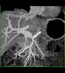 Metastatic Colon Cancer With Hypovascular Metastases - CTisus CT Scan