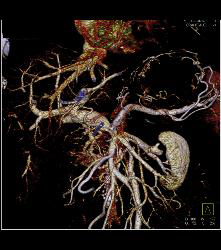 Metastatic Colon Cancer With Hypovascular Metastases - CTisus CT Scan