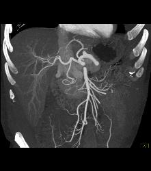 Metastatic Colon Cancer With Hypovascular Metastases - CTisus CT Scan