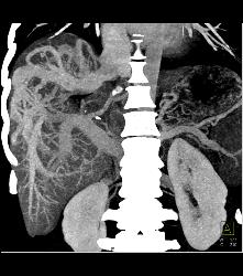 Hepatic Arteriovenous Malformations (AVMs) With Shunting - CTisus CT Scan