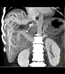 Hepatic Arteriovenous Malformations (AVMs) With Shunting - CTisus CT Scan