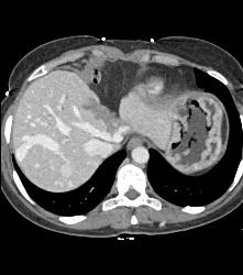 Hepatic Arteriovenous Malformations (AVMs) With Shunting - CTisus CT Scan