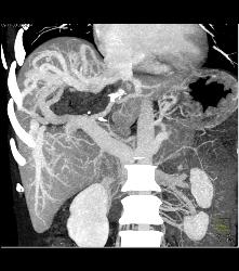 Hepatic Arteriovenous Malformations (AVMs) With Shunting - CTisus CT Scan